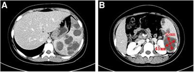 Case report: a case of multiple splenic abscesses in a child and literature review